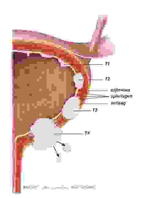 Fig2 tumorstadia