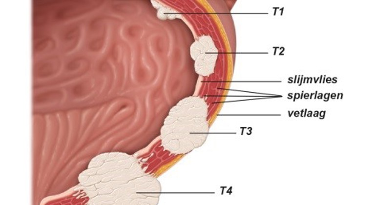 Fig2 tumorstadia