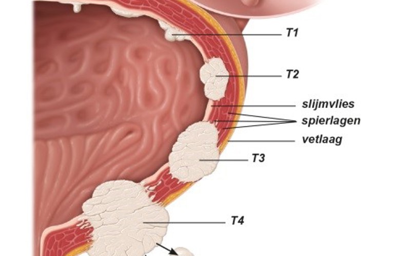 Fig2 tumorstadia