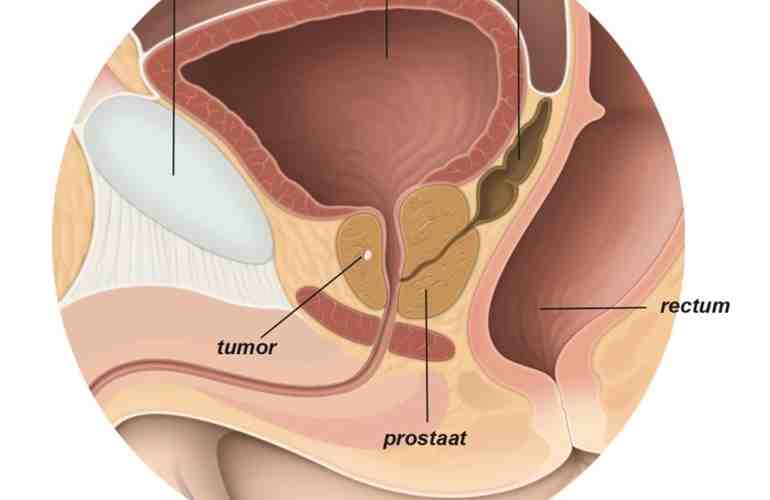 Prostaatkanker Fig 9