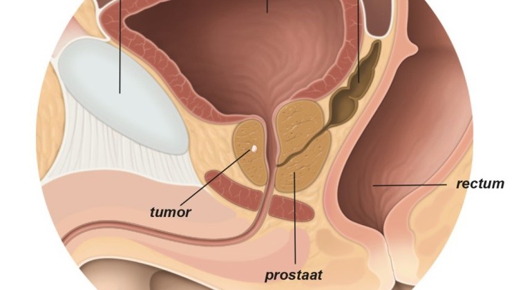 Prostaatkanker Fig 9